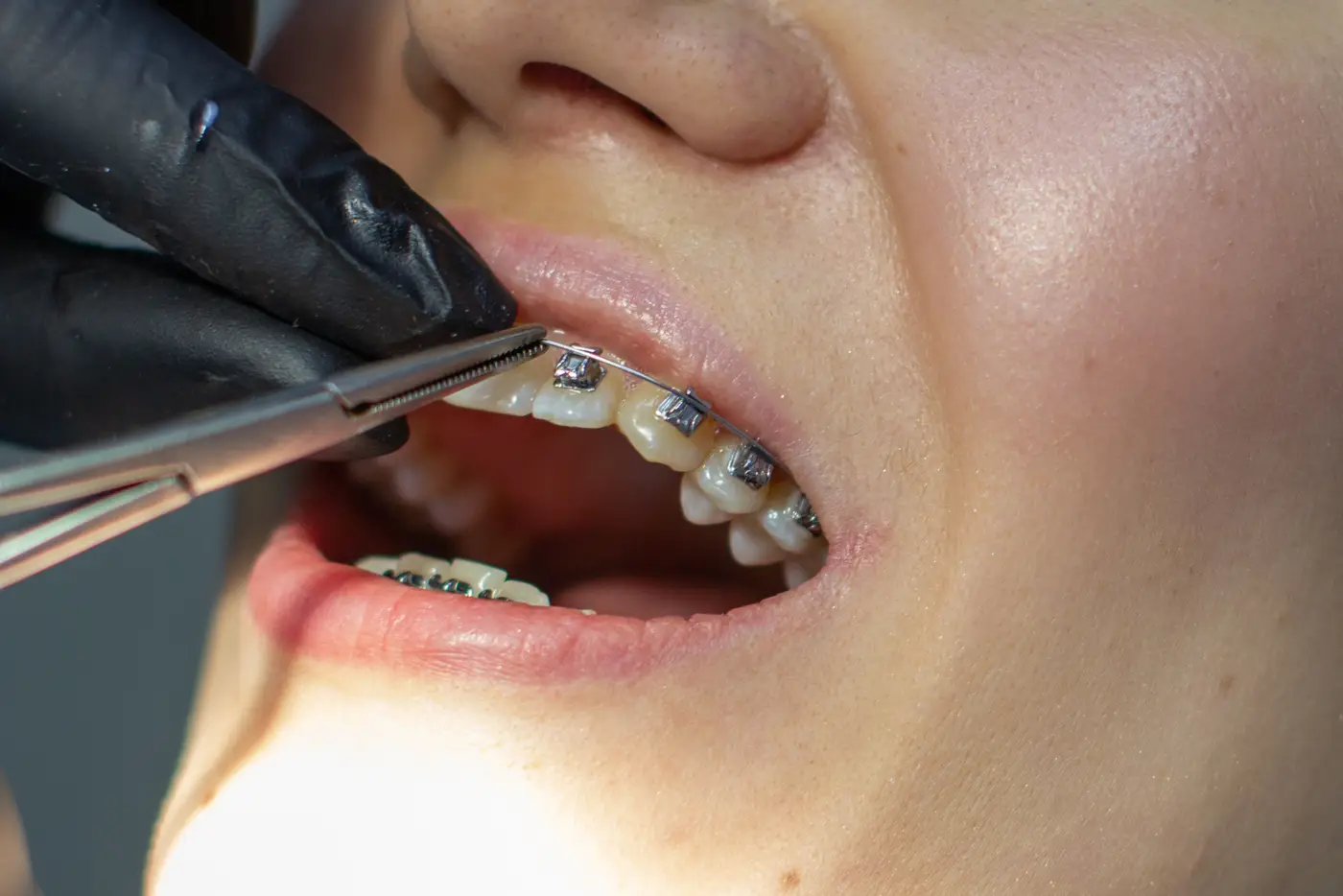 NuDental Bradford fixed metal braces ceramic braces orthodontic treatment Dr Attiya Ahmed